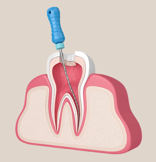 Re-Root Canal Treatment Illustration